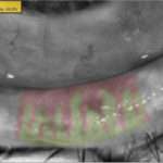 Meibomiografia post ciclo di trattamenti di luce pulsata: la perdita di ghiandole di Meibomio si è ridotta al 49.5%