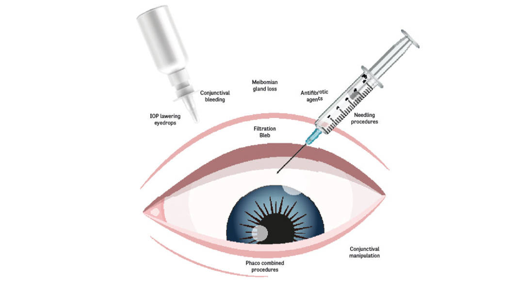 chirurgia del glaucoma