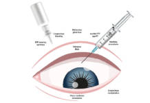 chirurgia del glaucoma