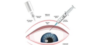 chirurgia del glaucoma