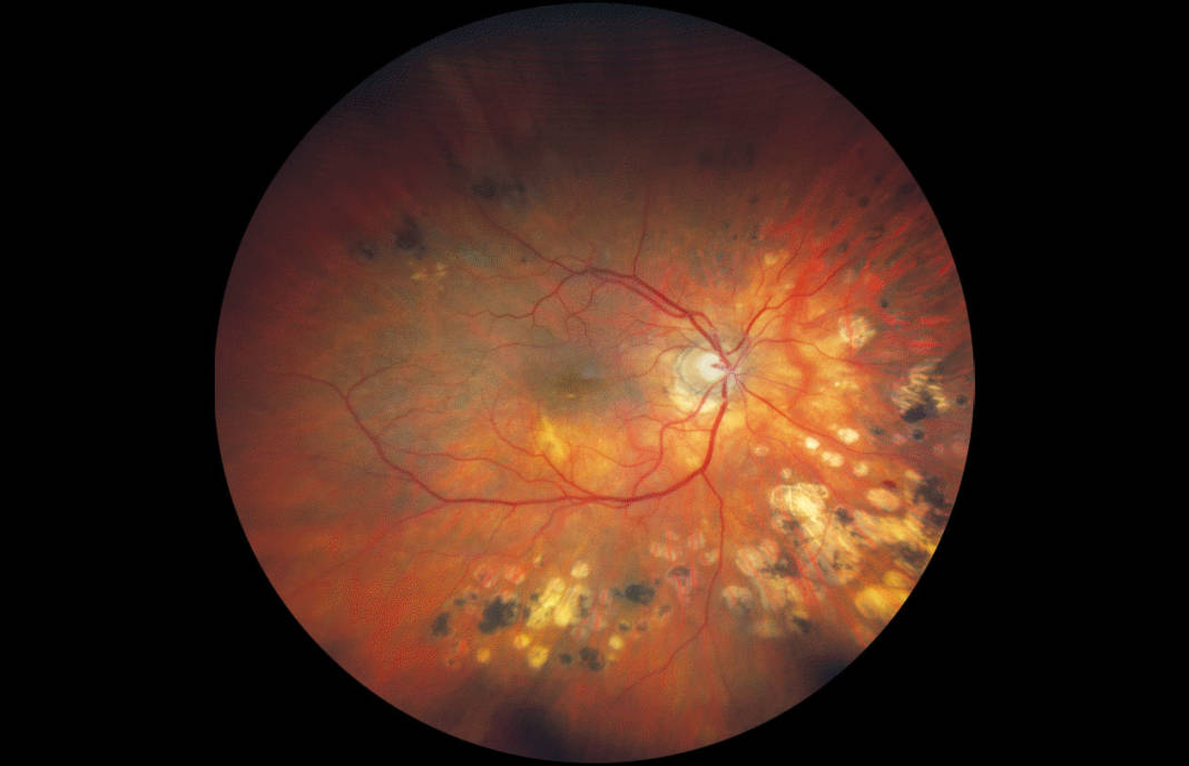 fundus di un paziente affetto da glaucoma